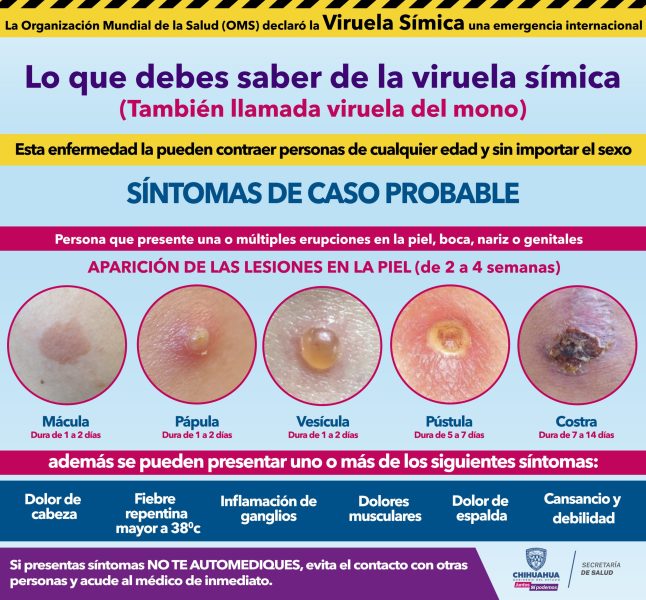 Reportan cinco casos de viruela del mono en Chihuahua