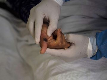 Salud confirma caso importado de viruela del mono en la CDMX; el paciente está aislado y estable